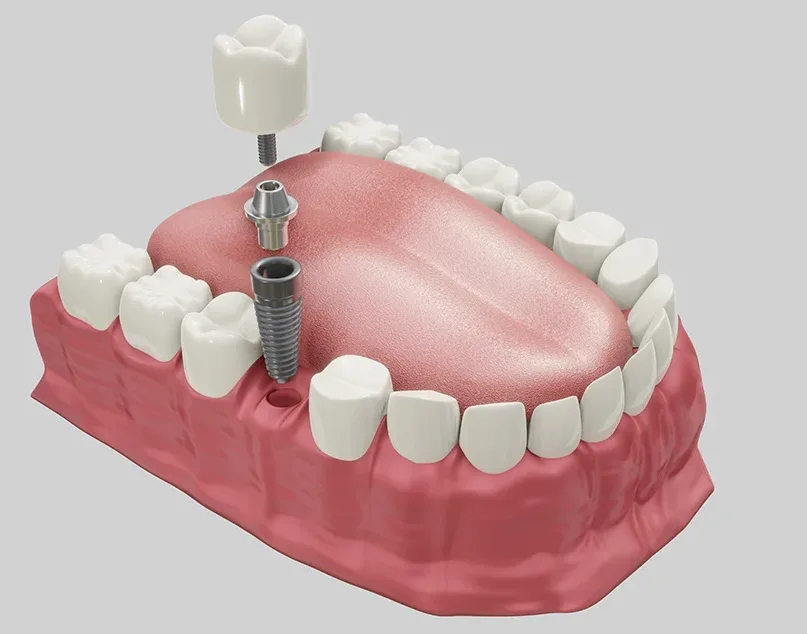 Ilustração de implante dentário: pino de titânio, pilar e coroa