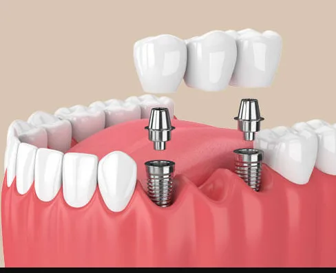 Ponte fixa apoiada sobre dois implantes